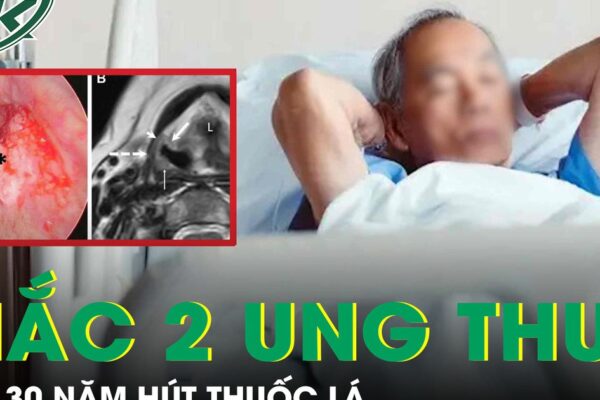 Người đàn ông 56 tuổi mắc cùng lúc hai ung thư sau 30 năm hút thuốc lá