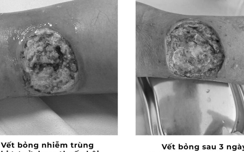 Tự chữa bỏng bằng thuốc dân gian, người đàn ông suýt hoại tử chân