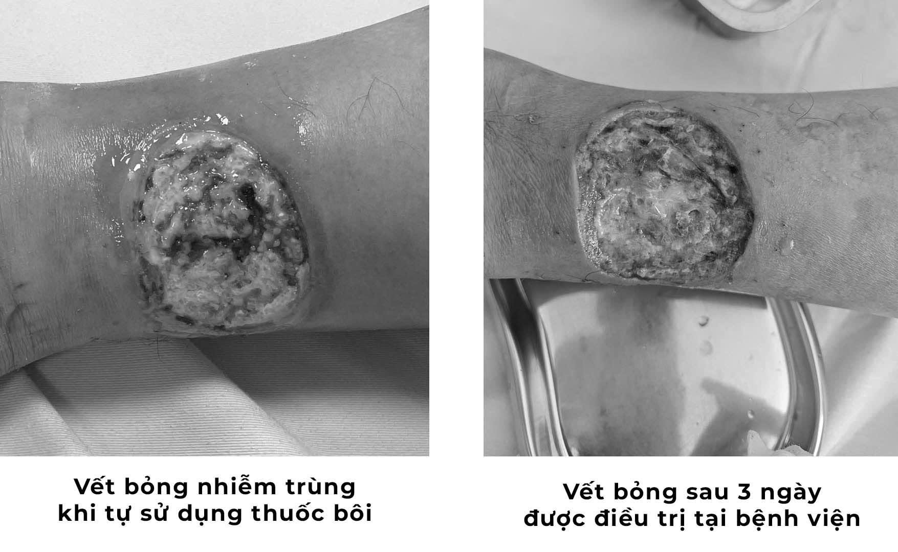 Tự chữa bỏng bằng thuốc dân gian, người đàn ông suýt hoại tử chân- Ảnh 1.