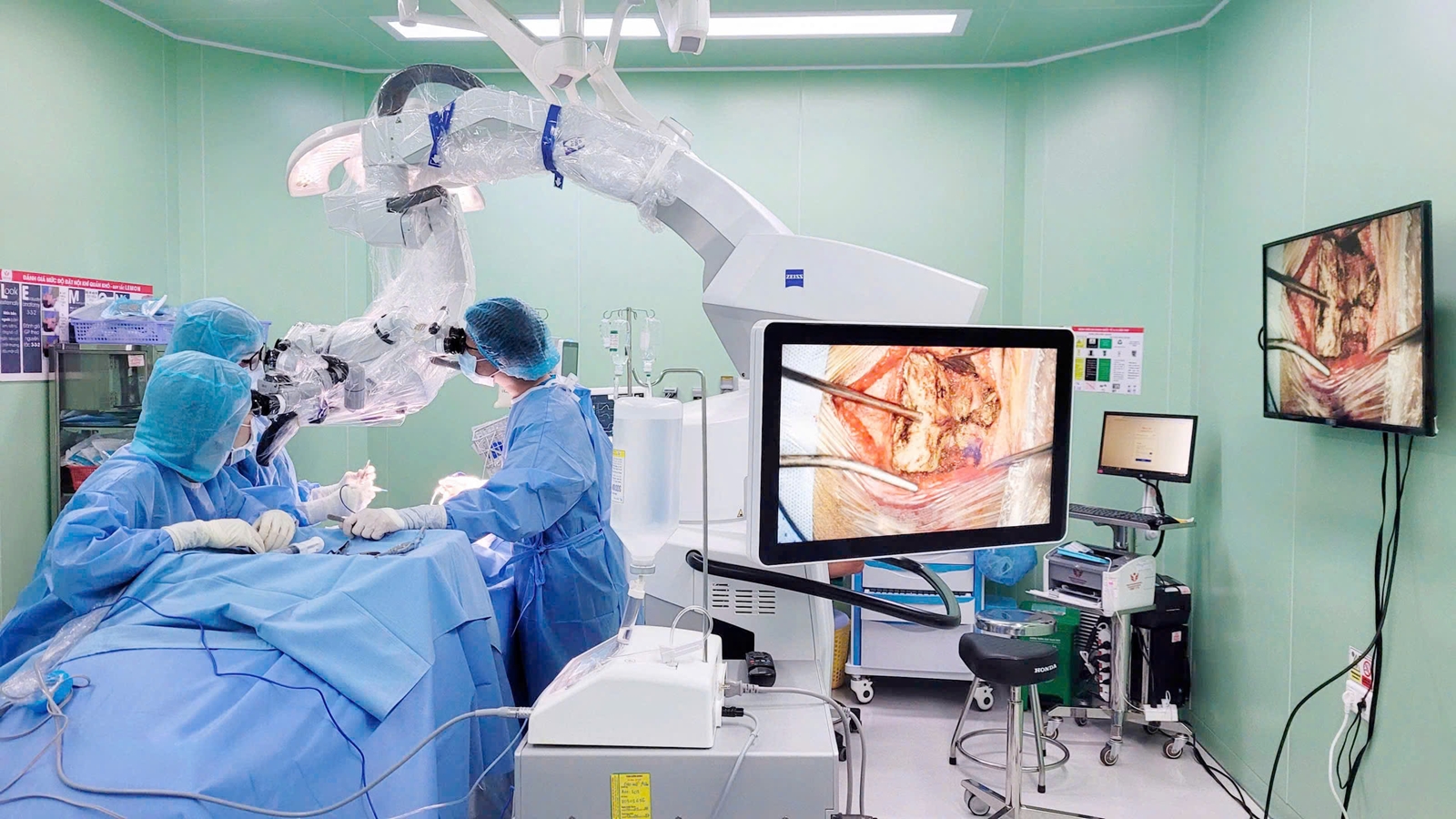 z77829880659677ec5cd3d2f93af89de636f7b87d94232-17776982200421862436121 Cứu sống cụ bà 86 tuổi bị túi phình động mạch não nhờ phẫu thuật lỗ khóa- Ảnh 1.