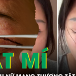 Tin lời ‘chuyên gia’ thẩm mỹ, người phụ nữ nhận kết cục đau đớn sau cắt mí mắt