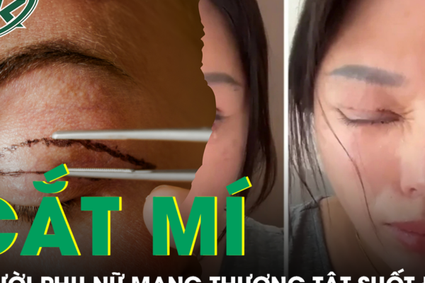 Tin lời ‘chuyên gia’ thẩm mỹ, người phụ nữ nhận kết cục đau đớn sau cắt mí mắt