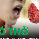 Khó thở mất tiếng, người phụ nữ phát hiện hơn 20 hạch ung thư di căn
