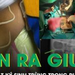 Bé trai 3 tuổi nôn ra giun, bác sĩ phẫu thuật lấy ra 3 bát ký sinh trùng trong ruột