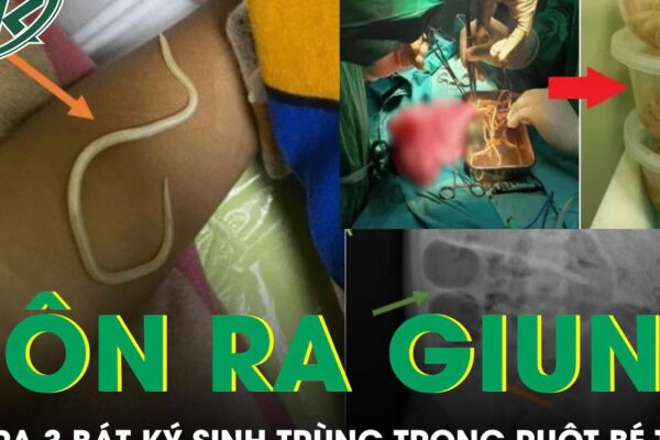 Bé trai 3 tuổi nôn ra giun, bác sĩ phẫu thuật lấy ra 3 bát ký sinh trùng trong ruột