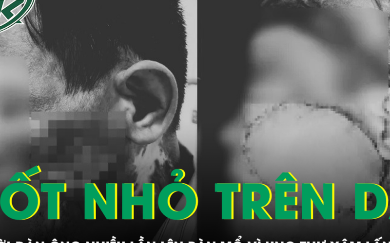 Chủ quan với nốt nhỏ trên da, người đàn ông nhiều lần phẫu thuật ung thư xâm lấn tái phát