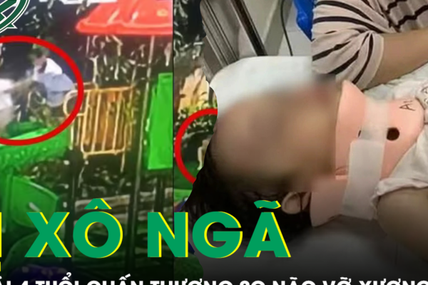 Bé gái 4 tuổi bị bạn xô ngã từ cầu trượt cao 1,5m chấn thương sọ não vỡ xương trán