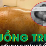 Bé gái 16 tuổi mang hai khối u buồng trứng khổng lồ gần 15kg, biến dạng toàn bộ ổ bụng