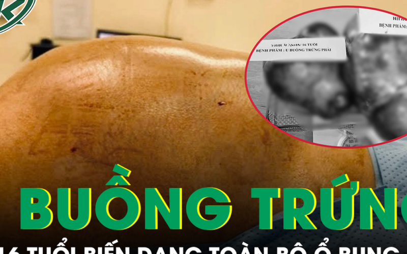 Bé gái 16 tuổi mang hai khối u buồng trứng khổng lồ gần 15kg, biến dạng toàn bộ ổ bụng