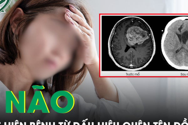 Liên tục quên tên đồ vật quen thuộc, người phụ nữ phát hiện khối u não nguy hiểm