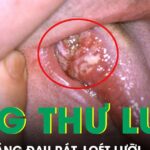 Loét lưỡi suốt 4 tháng, người đàn ông phát hiện ung thư ở tuổi 33