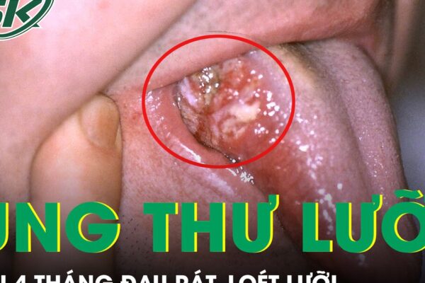 Loét lưỡi suốt 4 tháng, người đàn ông phát hiện ung thư ở tuổi 33