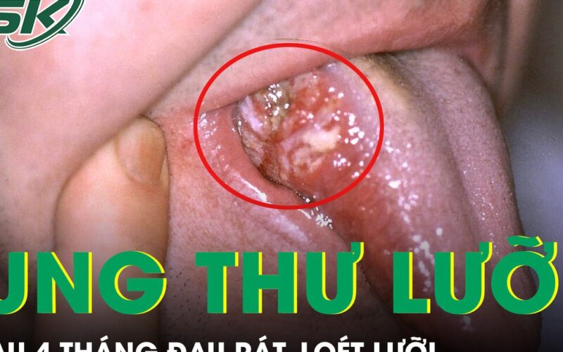 Loét lưỡi suốt 4 tháng, người đàn ông phát hiện ung thư ở tuổi 33