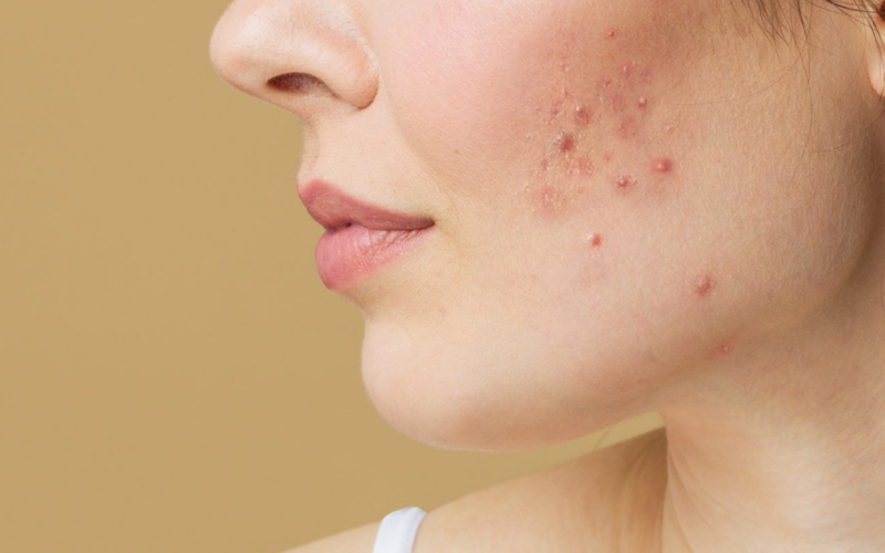 Da bùng mụn ngày hè: Nên chọn sản phẩm ngừa mụn nào?