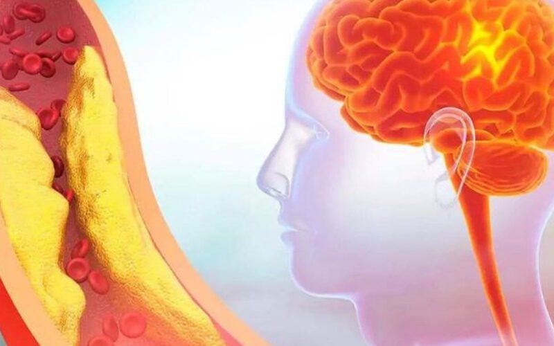 5 dấu hiệu cảnh báo thiếu máu não do hẹp động mạch cảnh