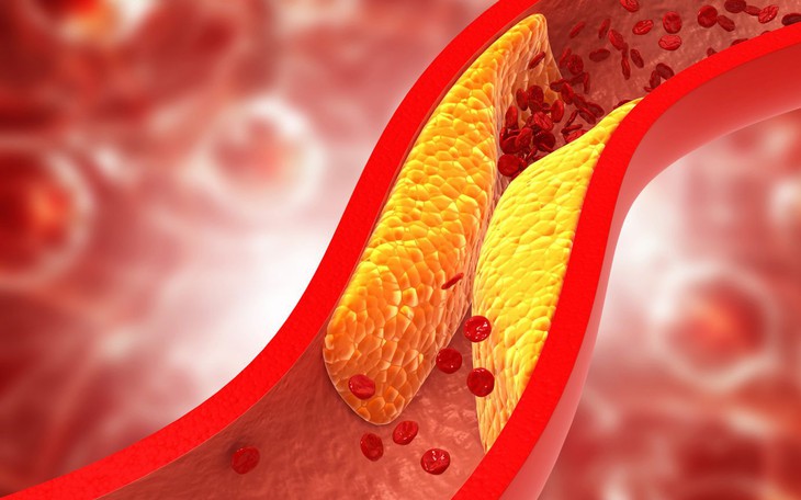 Thay đổi lối sống giúp kiểm soát cholesterol cao, giảm nguy cơ bệnh tim mạch- Ảnh 1.