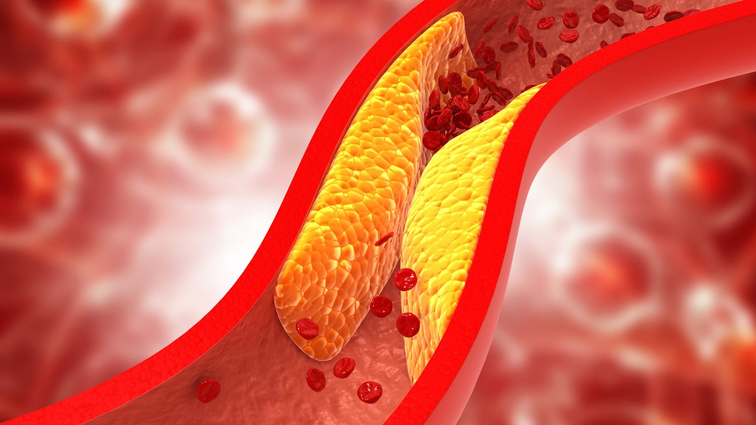 Thay đổi lối sống giúp kiểm soát cholesterol cao, giảm nguy cơ bệnh tim mạch- Ảnh 2.