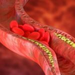 Thay đổi lối sống giúp kiểm soát cholesterol cao, giảm nguy cơ bệnh tim mạch