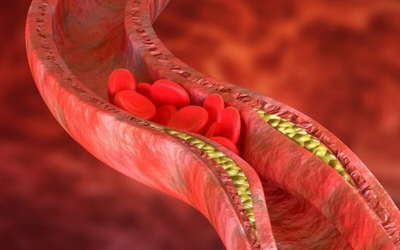 Thay đổi lối sống giúp kiểm soát cholesterol cao, giảm nguy cơ bệnh tim mạch