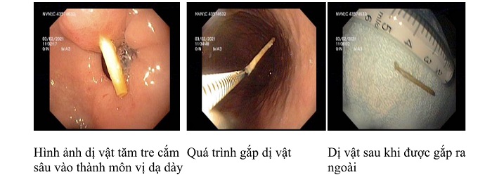 Thói quen ngậm tăm sau ăn hệ lụy khó lường- Ảnh 1.