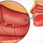 Nghẹt mũi, khó thở là biểu hiện của bệnh gì?
