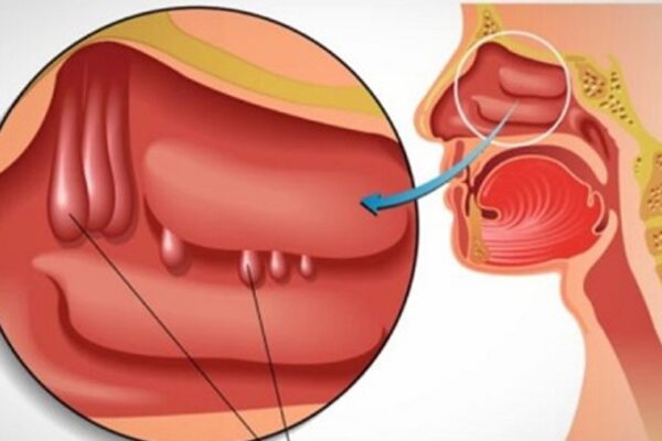 Nghẹt mũi, khó thở là biểu hiện của bệnh gì?