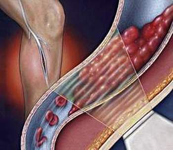 Viêm tắc động mạch chi - Ðừng để quá muộn