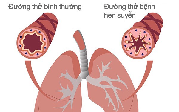 Đừng chủ quan với bệnh hen phế quản ở trẻ - Ảnh 1.