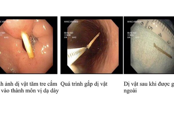 Thói quen ngậm tăm sau ăn hệ lụy khó lường
