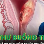 5 dấu hiệu cảnh báo sớm ung thư buồng trứng nhiều người bỏ qua
