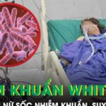 Người phụ nữ 43 tuổi sốc nhiễm khuẩn, suy đa tạng sau 5 ngày sốt