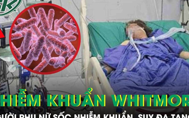 Người phụ nữ 43 tuổi sốc nhiễm khuẩn, suy đa tạng sau 5 ngày sốt