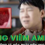 Tưởng viêm amidan, người đàn ông 60 tuổi ‘chết lặng’ phát hiện ung thư di căn