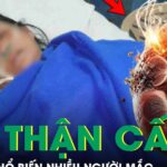 Cụ bà 76 tuổi hôn mê, suy thận cấp vì sai lầm phổ biến nhiều người mắc