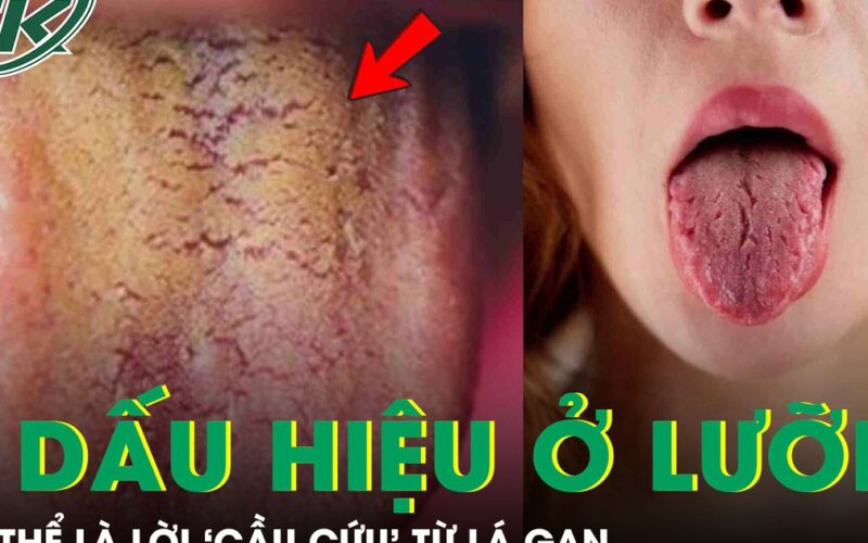 Đừng bỏ qua 3 dấu hiệu bất thường này trên lưỡi, có thể là lời ‘cầu cứu’ từ lá gan