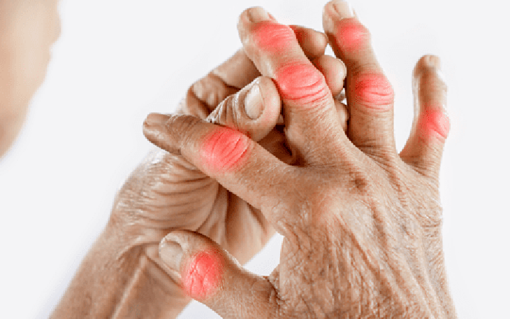 6 loại thực phẩm càng ăn nhiều càng gây đau khớp, viêm khớp- Ảnh 3.
