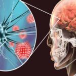 Viêm não tự miễn có nguy cơ tử vong cao nếu chẩn đoán muộn