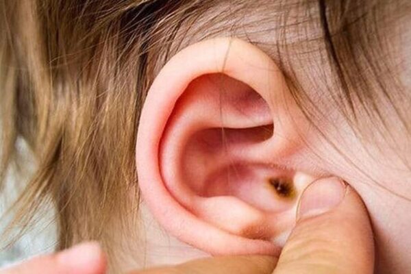 Dấu hiệu nhọt ống tai ngoài ở trẻ và cách xử trí đúng