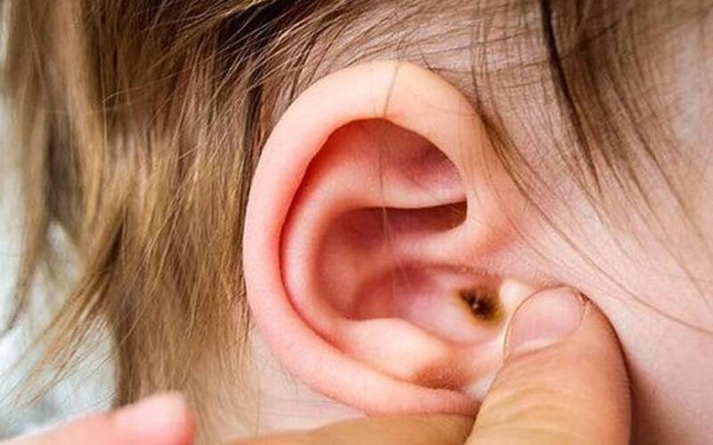 Dấu hiệu nhọt ống tai ngoài ở trẻ và cách xử trí đúng