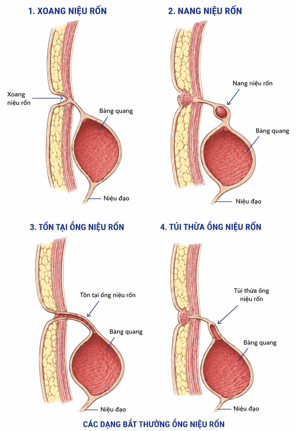 Bệnh viện Quân y 354: Phẫu thuật thành công ca xoang niệu rốn hiếm gặp ở người trưởng thành- Ảnh 2.