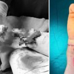 Nối thành công bàn tay bị đứt rời cho người phụ nữ bị tai nạn do máy cưa