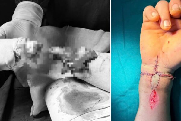 Nối thành công bàn tay bị đứt rời cho người phụ nữ bị tai nạn do máy cưa