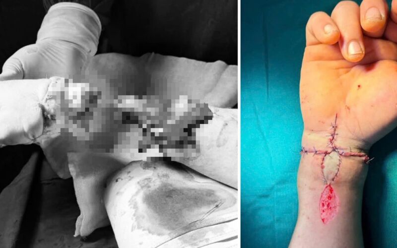 Nối thành công bàn tay bị đứt rời cho người phụ nữ bị tai nạn do máy cưa