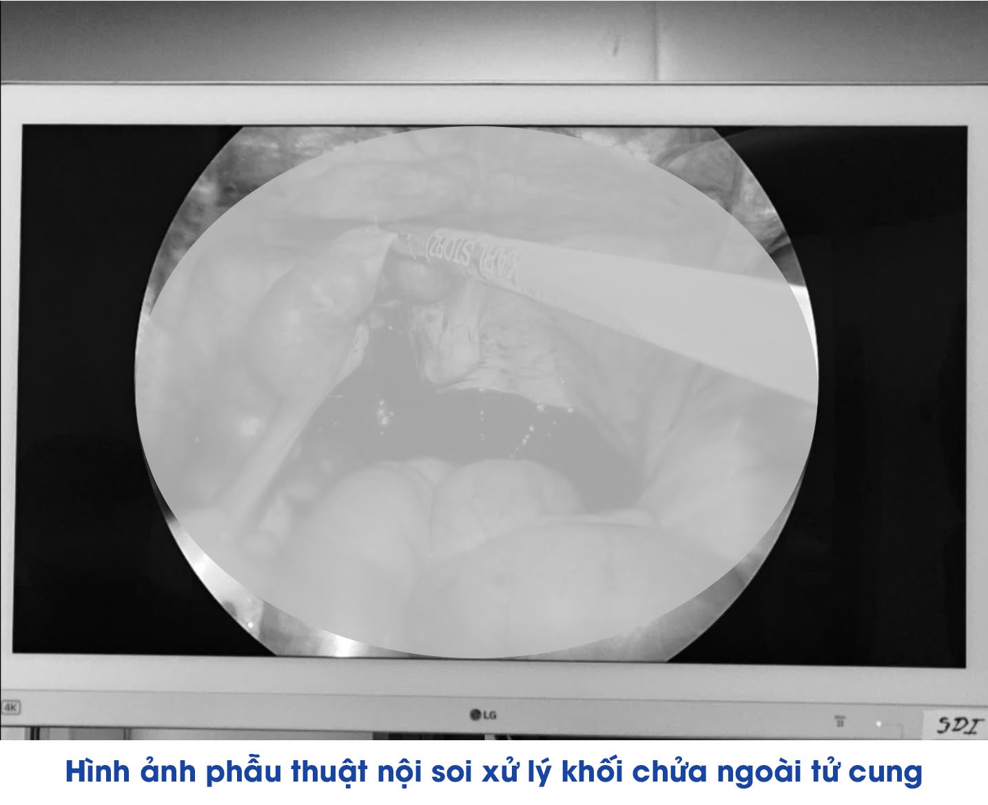 hinh-anh-phau-thuat-noi-soi-xu-ly-khoi-chua-ngoai-tu-cung-1781324423101907823996 Liên tiếp cứu sống nhiều phụ nữ chửa ngoài tử cung vỡ tại Bệnh viện Đa khoa Khu vực Vân Đồn - Ảnh 2.
