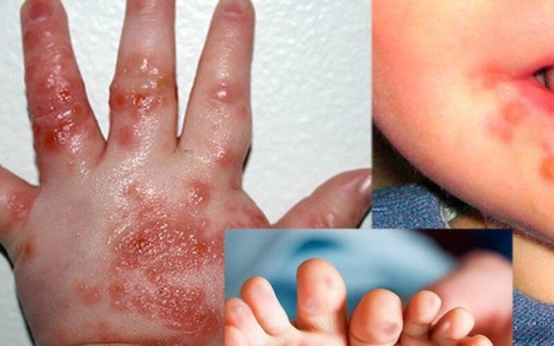 Lâm Đồng ghi nhận 2.265 ca mắc tay chân miệng, một ca tử vong do chủng EV71
