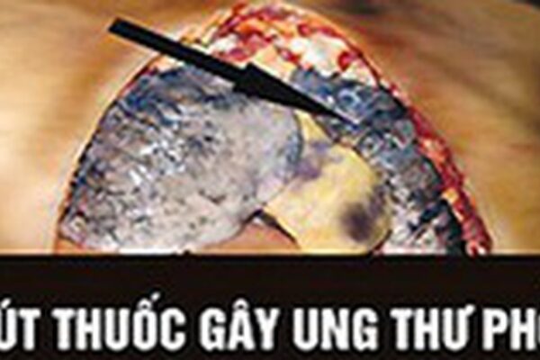WHO: Cảnh báo trên bao bì thuốc lá là cách truyền thông hiệu quả, ít tốn kém