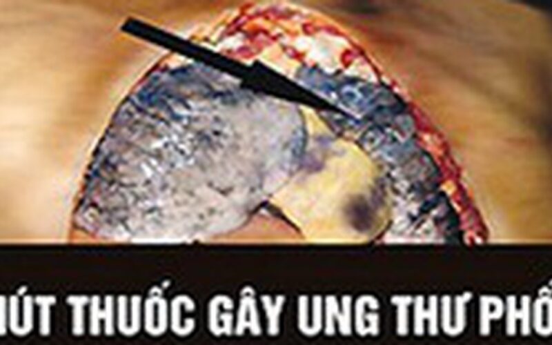 WHO: Cảnh báo trên bao bì thuốc lá là cách truyền thông hiệu quả, ít tốn kém
